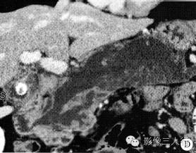 【病例】胰腺体尾部导管内乳头状黏液性囊腺癌1例CT及MR影像表现 【病例】胰腺体尾部导管内乳头状黏液性囊腺癌1例CT及MR影像表现