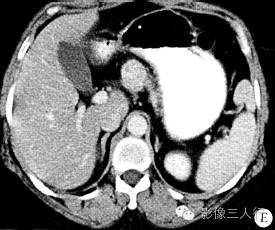【病例】胰头部类癌1例CT影像表现 【病例】胰头部类癌1例CT影像表现