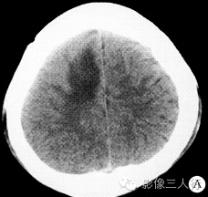 【病例】右额叶脑囊虫病1例CT及MR影像表现
