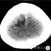 【病例】右额叶脑囊虫病1例CT及MR影像表现 【病例】右额叶脑囊虫病1例CT及MR影像表现
