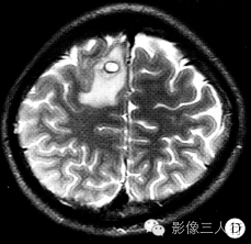 【病例】右额叶脑囊虫病1例CT及MR影像表现 【病例】右额叶脑囊虫病1例CT及MR影像表现
