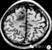 【病例】右额叶脑囊虫病1例CT及MR影像表现 【病例】右额叶脑囊虫病1例CT及MR影像表现