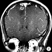【病例】右额叶脑囊虫病1例CT及MR影像表现 【病例】右额叶脑囊虫病1例CT及MR影像表现
