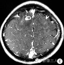 【病例】右额叶脑囊虫病1例CT及MR影像表现 【病例】右额叶脑囊虫病1例CT及MR影像表现