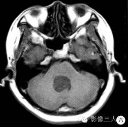 【病例】四脑室内脉络丛乳头状瘤1例MR影像表现