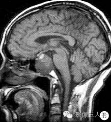 【病例】鞍内脊索瘤1例CT及MR影像表现