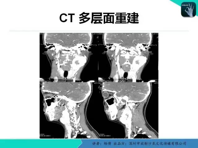 【病例】颈动脉体瘤1例影像诊断