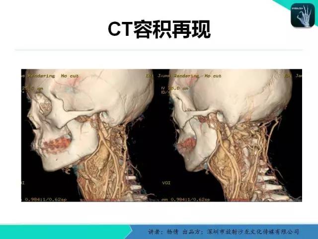 【病例】颈动脉体瘤1例影像诊断