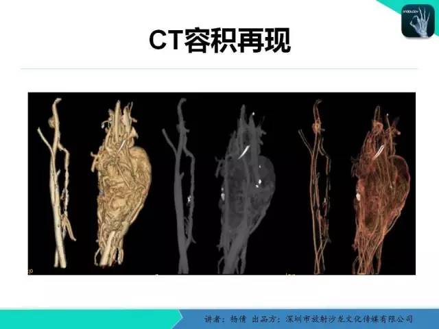 【病例】颈动脉体瘤1例影像诊断