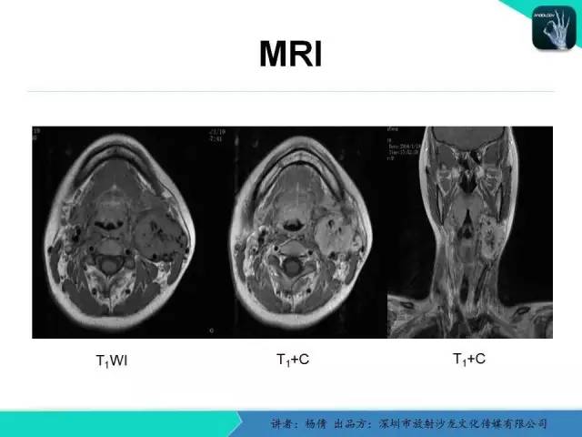 【病例】颈动脉体瘤1例影像诊断