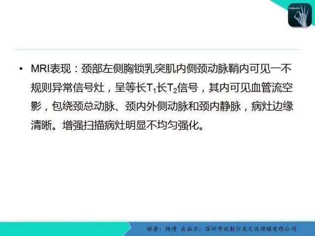 【病例】颈动脉体瘤1例影像诊断