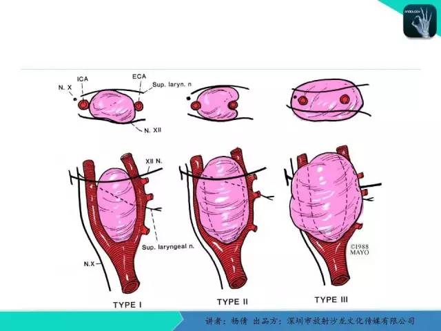 【病例】颈动脉体瘤1例影像诊断