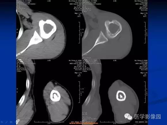 【病例】左肱骨骨纤维结构不良1例CT影像表现 【病例】左肱骨骨纤维结构不良1例CT影像表现
