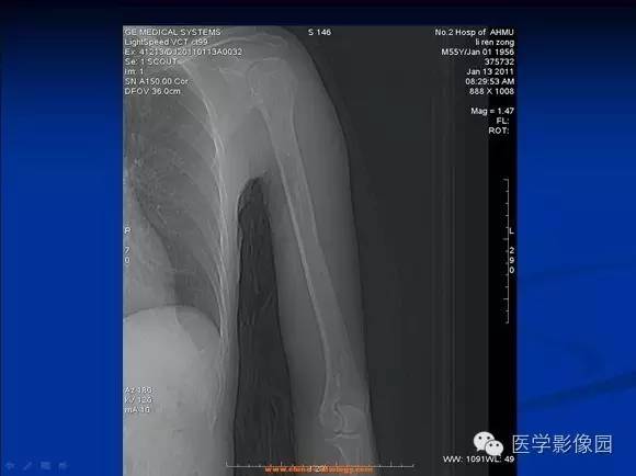 【病例】左肱骨骨纤维结构不良1例CT影像表现 【病例】左肱骨骨纤维结构不良1例CT影像表现
