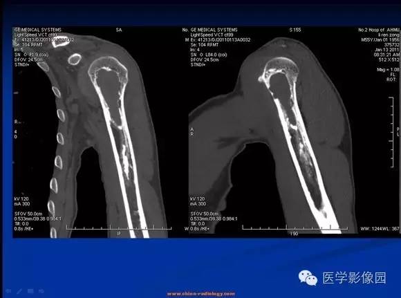 【病例】左肱骨骨纤维结构不良1例CT影像表现 【病例】左肱骨骨纤维结构不良1例CT影像表现