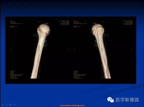 【病例】左肱骨骨纤维结构不良1例CT影像表现 【病例】左肱骨骨纤维结构不良1例CT影像表现