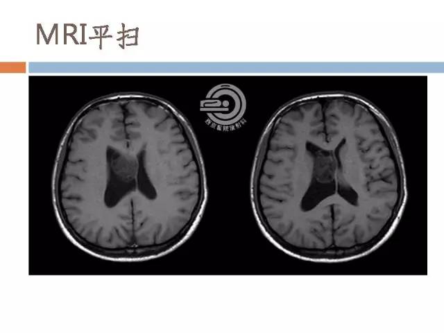 【病例】右侧脑室星形细胞瘤WHOII级一例MR影像表现