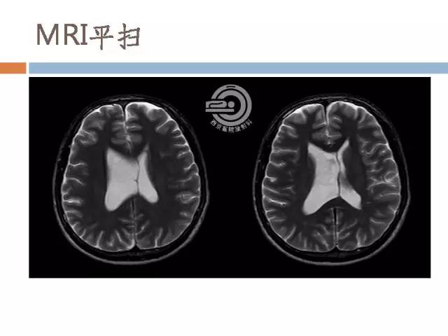 【病例】右侧脑室星形细胞瘤WHOII级一例MR影像表现