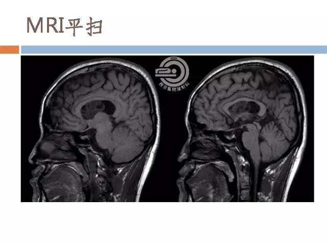 【病例】右侧脑室星形细胞瘤WHOII级一例MR影像表现