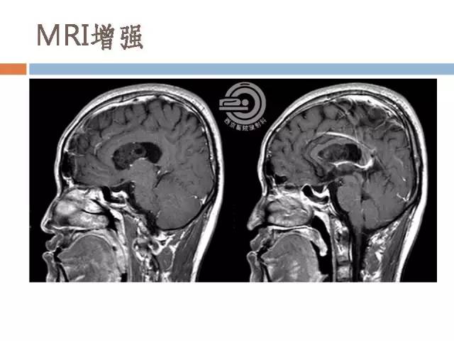 【病例】右侧脑室星形细胞瘤WHOII级一例MR影像表现