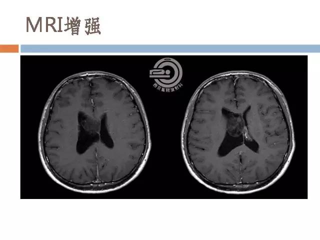 【病例】右侧脑室星形细胞瘤WHOII级一例MR影像表现