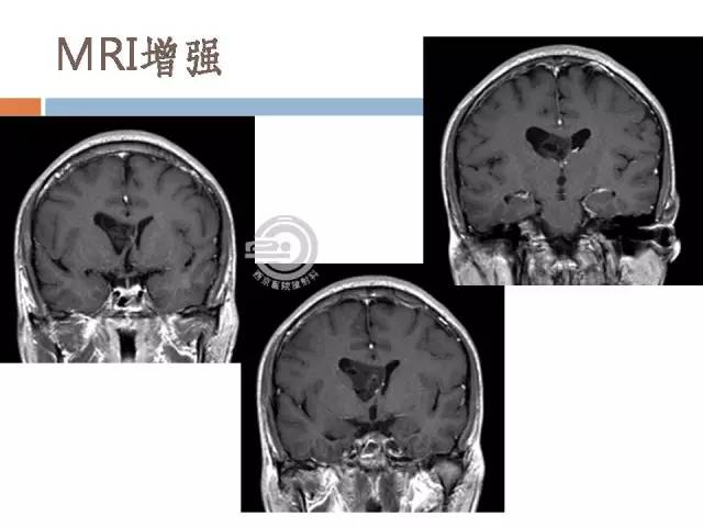 【病例】右侧脑室星形细胞瘤WHOII级一例MR影像表现