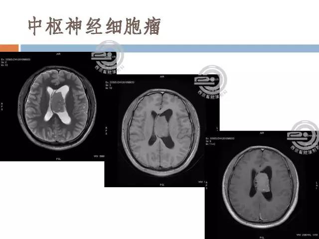 【病例】右侧脑室星形细胞瘤WHOII级一例MR影像表现