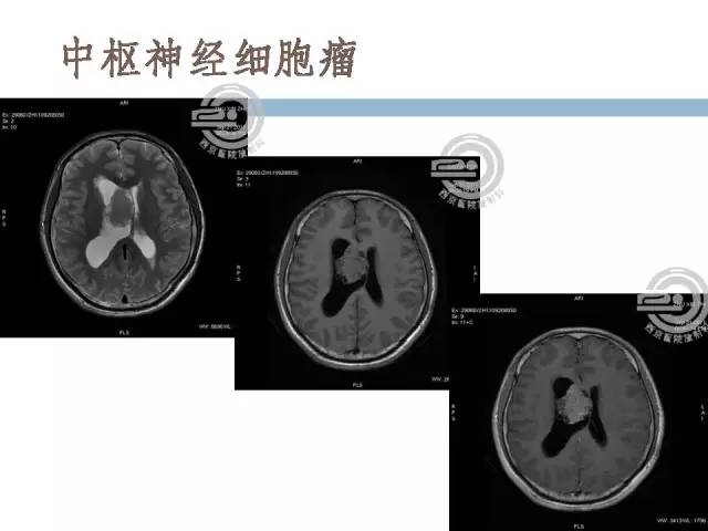 【病例】右侧脑室星形细胞瘤WHOII级一例MR影像表现