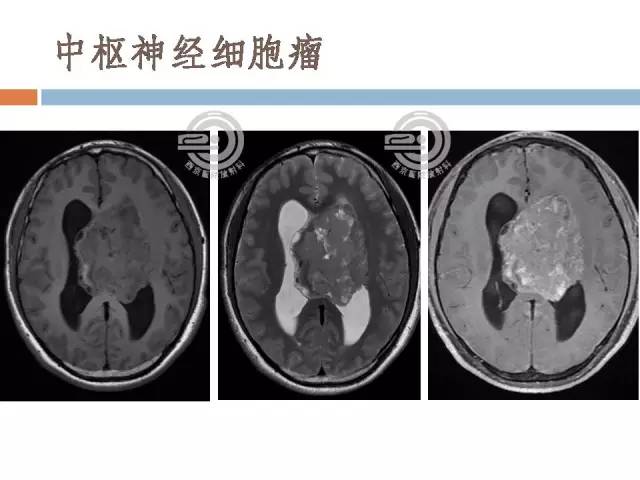 【病例】右侧脑室星形细胞瘤WHOII级一例MR影像表现