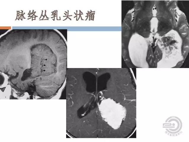 【病例】右侧脑室星形细胞瘤WHOII级一例MR影像表现