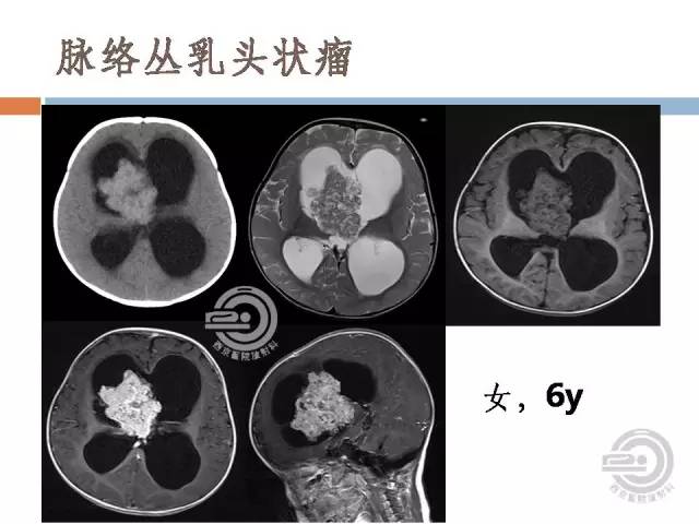 【病例】右侧脑室星形细胞瘤WHOII级一例MR影像表现