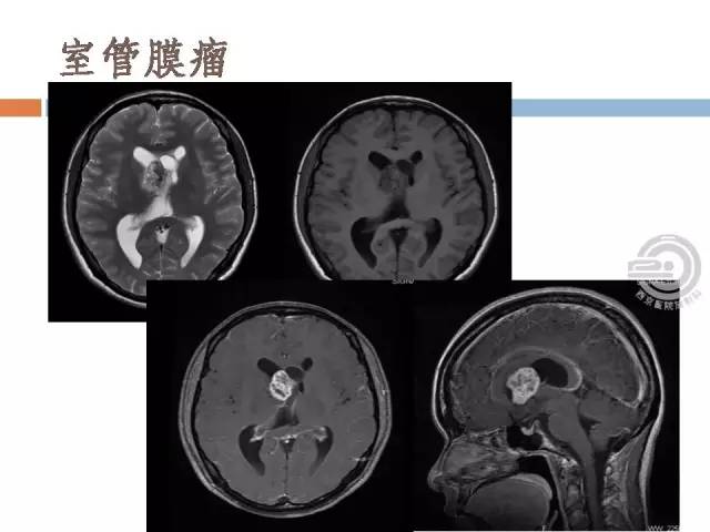 【病例】右侧脑室星形细胞瘤WHOII级一例MR影像表现