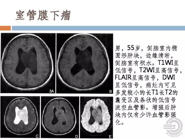 【病例】右侧脑室星形细胞瘤WHOII级一例MR影像表现