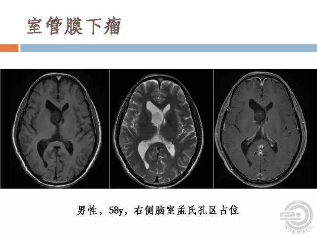 【病例】右侧脑室星形细胞瘤WHOII级一例MR影像表现