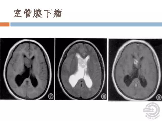 【病例】右侧脑室星形细胞瘤WHOII级一例MR影像表现