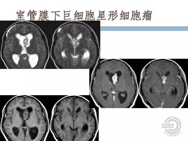 【病例】右侧脑室星形细胞瘤WHOII级一例MR影像表现