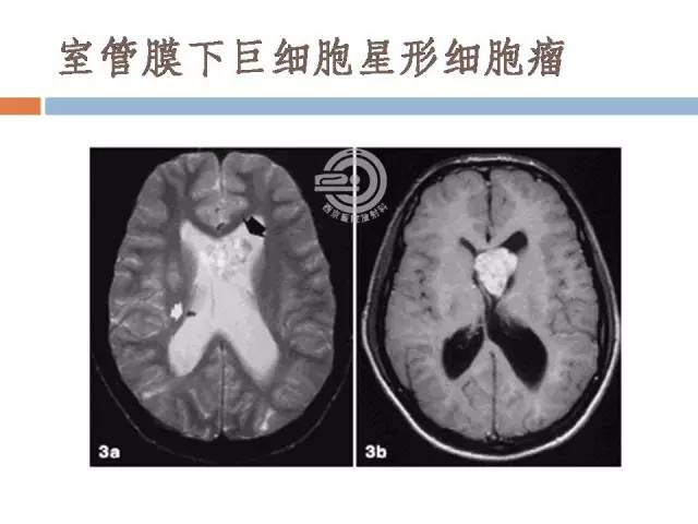 【病例】右侧脑室星形细胞瘤WHOII级一例MR影像表现