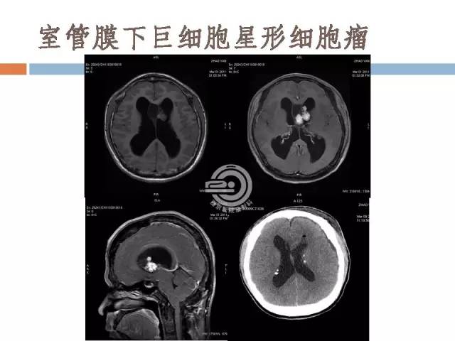 【病例】右侧脑室星形细胞瘤WHOII级一例MR影像表现