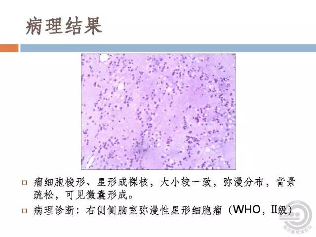 【病例】右侧脑室星形细胞瘤WHOII级一例MR影像表现