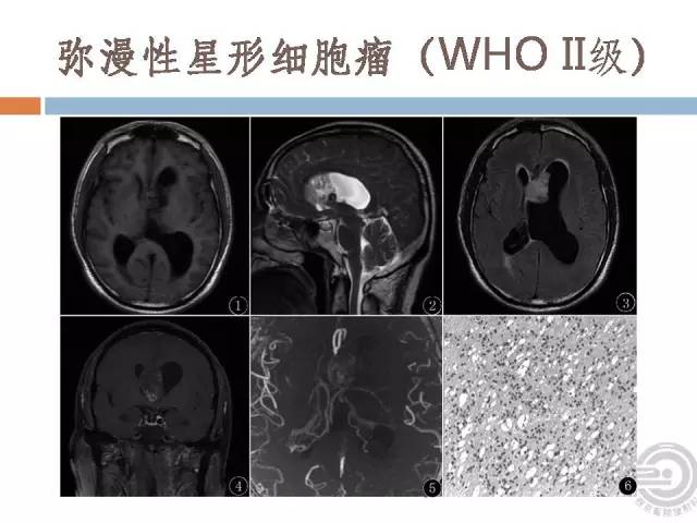 【病例】右侧脑室星形细胞瘤WHOII级一例MR影像表现