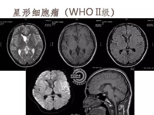 【病例】右侧脑室星形细胞瘤WHOII级一例MR影像表现