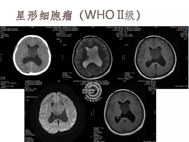 【病例】右侧脑室星形细胞瘤WHOII级一例MR影像表现