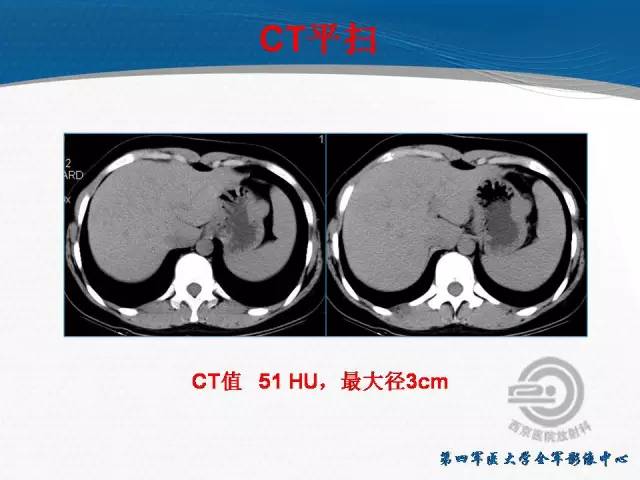 【病例】胃体神经内分泌肿瘤1例CT影像表现