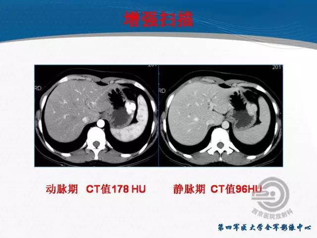 【病例】胃体神经内分泌肿瘤1例CT影像表现