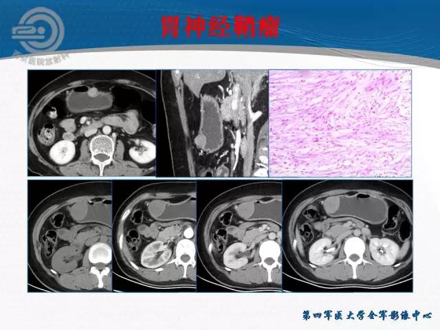 【病例】胃体神经内分泌肿瘤1例CT影像表现