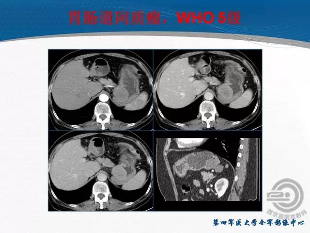 【病例】胃体神经内分泌肿瘤1例CT影像表现