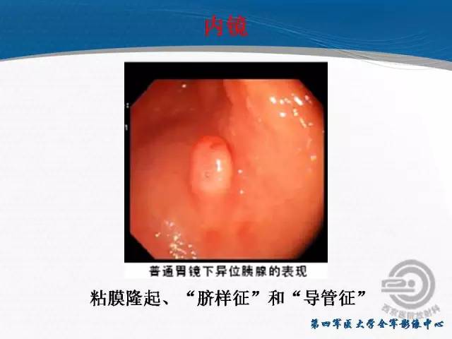 【病例】胃体神经内分泌肿瘤1例CT影像表现