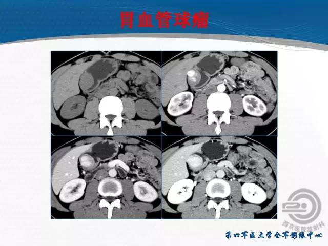 【病例】胃体神经内分泌肿瘤1例CT影像表现