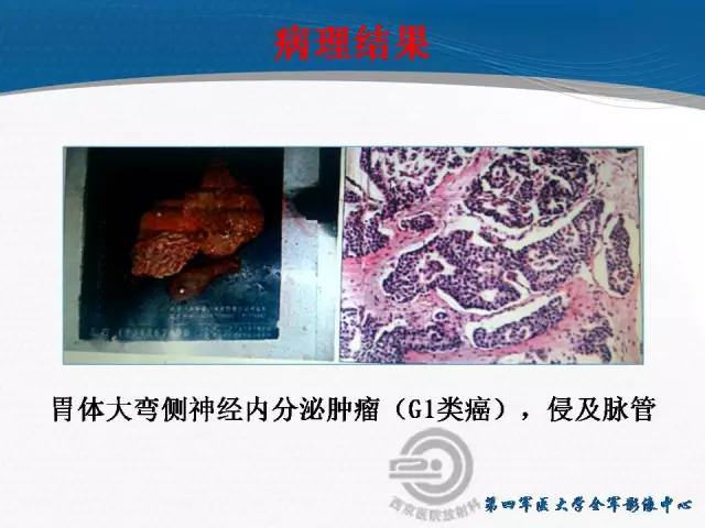 【病例】胃体神经内分泌肿瘤1例CT影像表现