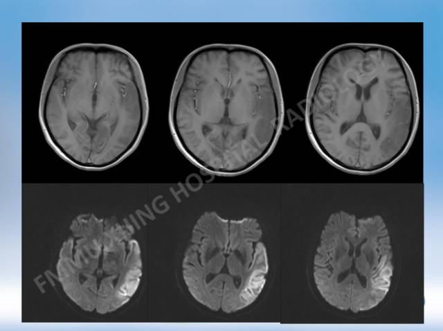 【病例】线粒体脑肌病1例MR影像表现